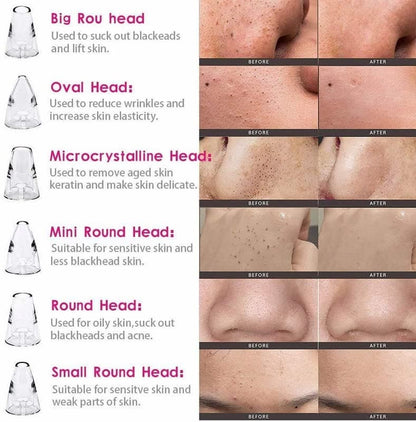 ⭐ DermaGlow 5-in-1 Blackhead Vacuum Pore Cleaner